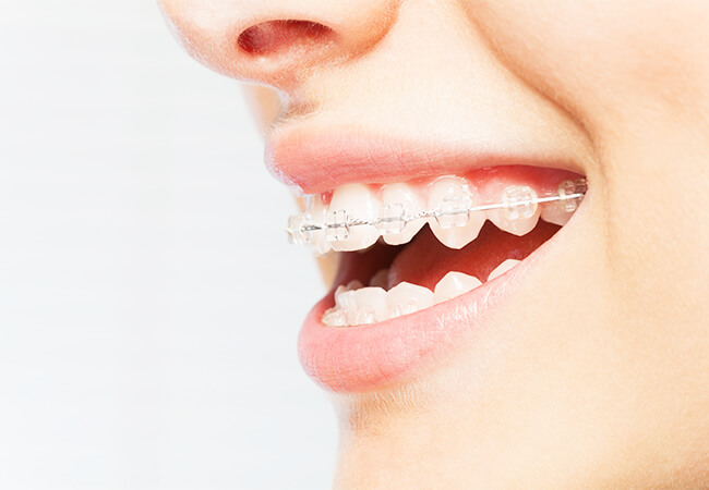 歯列矯正装置をつけた女性