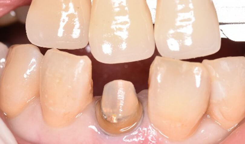 インプラント直後の様子